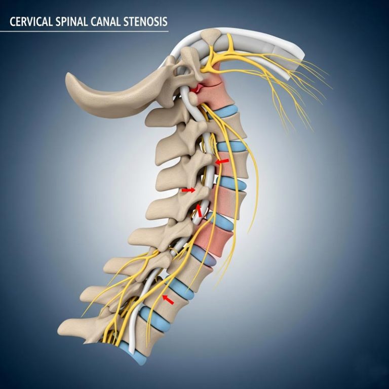 Cervical Spinal Canal Stenosis