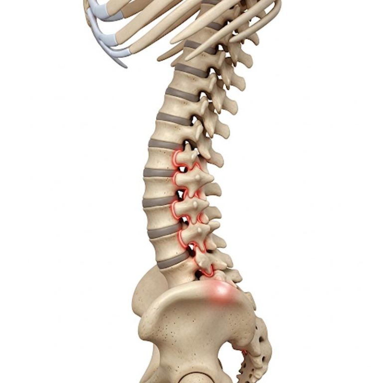 Spondylitis